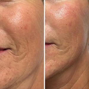 Filling up the skin with Hyaluronic Acid After one procedure
