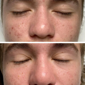before and after Anna Yermenson Skin Treatment